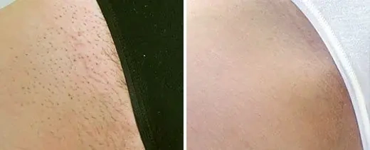 Odstranjevanje dlak - bikini